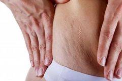 Премахване на Стрии със Сода Бикарбонат