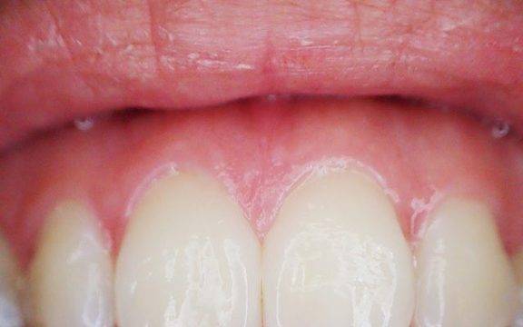 Какво да знаем за отдръпващите се венци