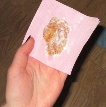 Медена превръзка: Лекува силна кашлица при деца и възрастни само за една вечер!