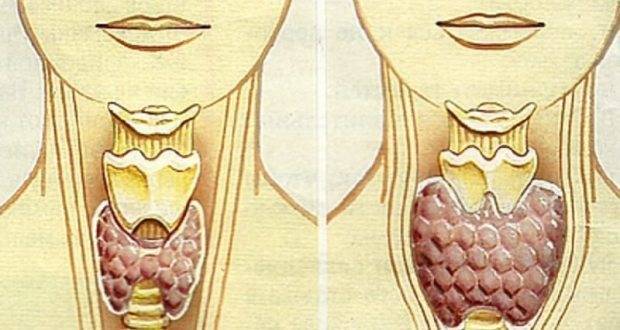 Провериха с ултразвук: Щитовидната ми жлеза е вече нормална, отне ми 2 месеца! (как не сме знаели за този лек)