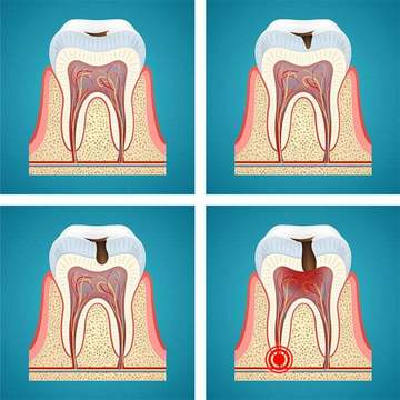 Как се лекува кариес?