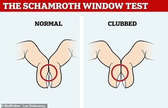 Симптом на Шамрот (Шамро) при онкоболни