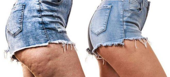 Как да се отървем от целулита?