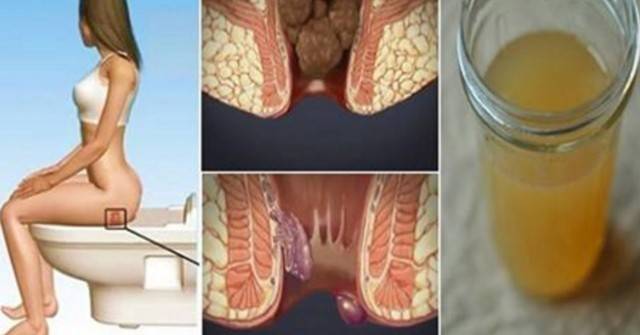 Лечение на хемороиди у дома: С една съставка от Вашата Кухня, ще се отървете от тях в рамките на няколко дни