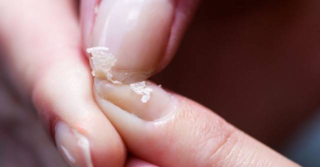 Ноктите ви се разделят и чупят! Вземете мерки, защото дефицитът на този важен микроелемент води до усложнения! Най-честите…