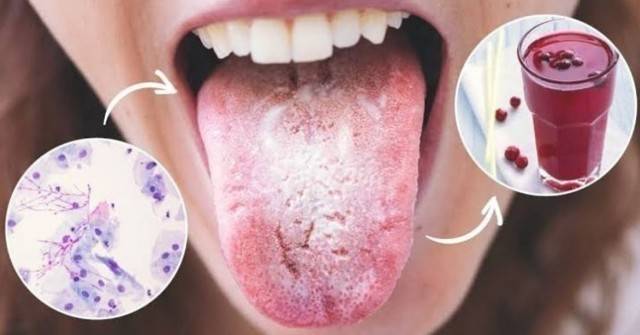 Как да премахнем кандида и предотвратим по естествен начин