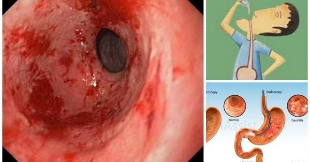 Нощем ме изгаряха киселини, а от гастрита се свивах на две от болка! Добре че всичко е минало, откакто глезя стомахчето с това:
