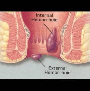 Невероятна рецепта лекува хемороиди