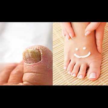 Как да излекуваме гъбичките по краката за 1 седмица?