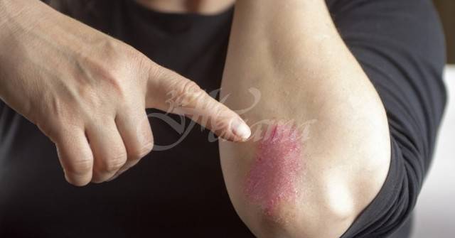 Аз се излекувах от псориазис с помощта на нещо толкова просто! Това никой не си го спомня!