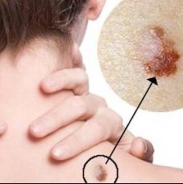 Това са скритите симптоми на полово предаваните болести