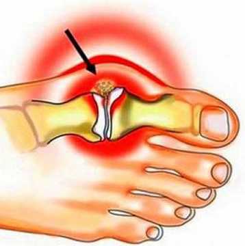 Чудодейна смес за деформираните кости на ръцете и краката