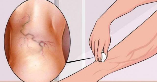 Презирах разширените си вени, но се отървах от тях завинаги само с използването на една проста съставка!