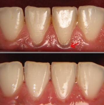 Как да се отървете от зъбния камък сами?