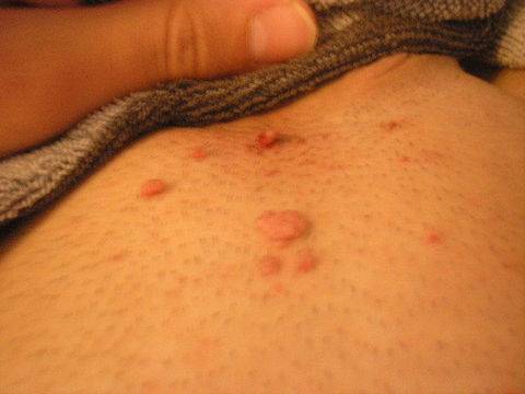 Можем ли да отстраним папиломите безопасно ?