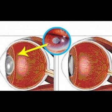 Изхвърлите очилата за дни! Тази една съставка ще ви помогне да увеличите зрението си с 97%-Ще виждате като орел!