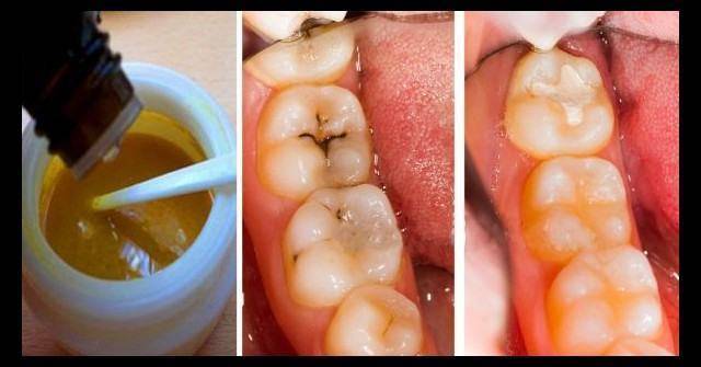 Забравих какво е зъболекар, откакто си правя тази домашна паста. Спряха да ми кървят венците и кариес не съм имала от години