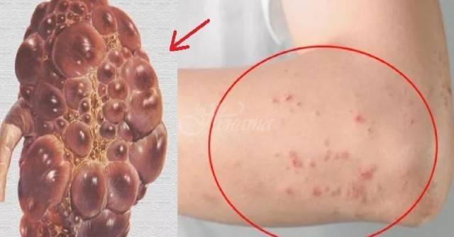 Тези 8 симптома говорят, че бъбреците ви не работят добре и трябва да вземете мерки, докато не е станало късно