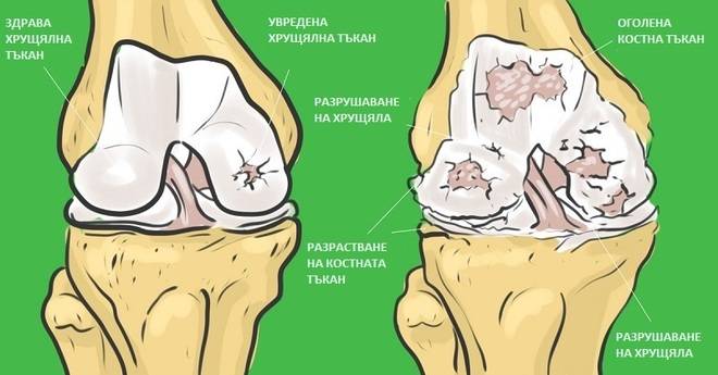 Желатинът спаси мама от операция на ставата! Сега не само не я боли, но има кожата и косата на 20-годишна!