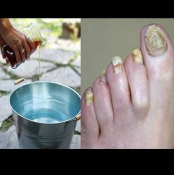 Потопете краката си само в тази смес и ще се отървете завинаги от гъбичките. Само 2 съставки и ще забравите за този проблем