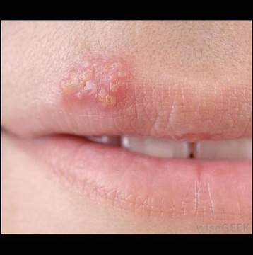 Отървете се от херпесът само с една съставка, която 100% имате вкъщи