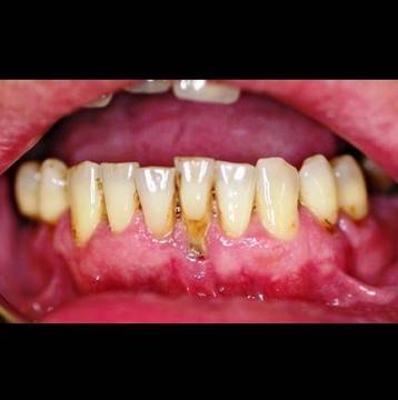 Ето как да излекувате пародонтоза с натурални средства вкъщи. Край на кървящите и оголени венци