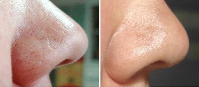 Изсмуква черните точки от носа и лицето по-ефикасно от прахосмукачка! Опитайте още днес!