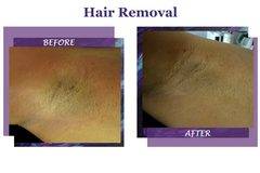 Какво е нужно да знаем за лазерната епилация