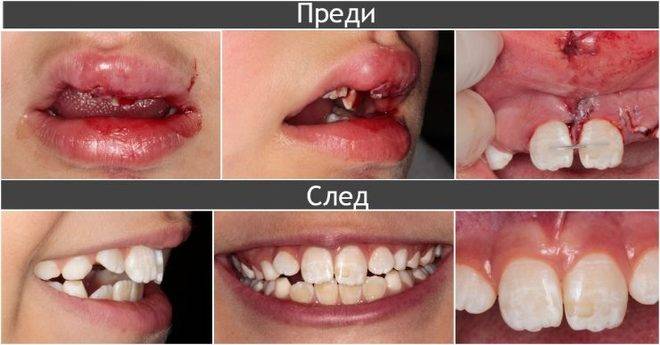 Спешни ситуации при травма и избити зъби!