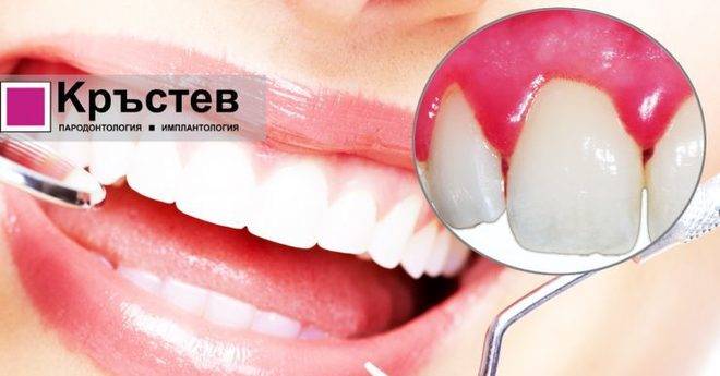 7 истински заблуди за пародонтита