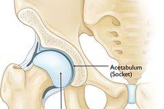 Kоксартроза: Степени, Причини и Лечение доказано Научно