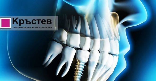 Поставяне на зъбни импланти – Варна – Клиника Кръстев