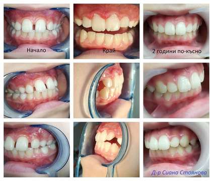 Избелване на зъби Варна