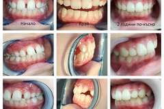 Избелване на зъби Варна