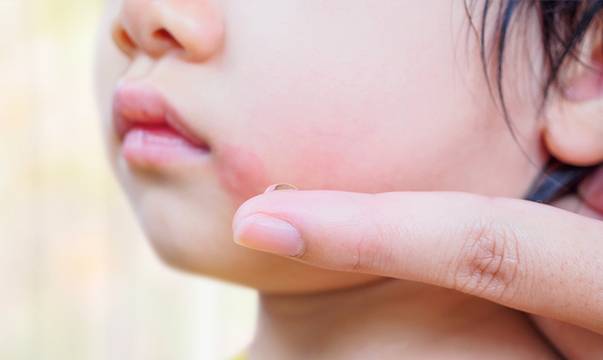 Атопичен дерматит при деца – лечение и причини