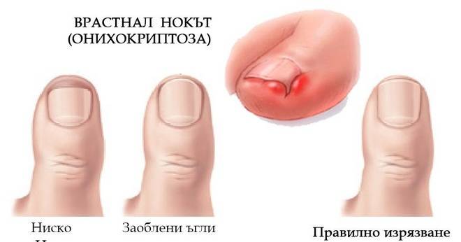 Врастнал нокът – онихокриптоза (unguis incarnatus, onychocryptosis) Д-р Галин ГАНЧЕВ – хирург