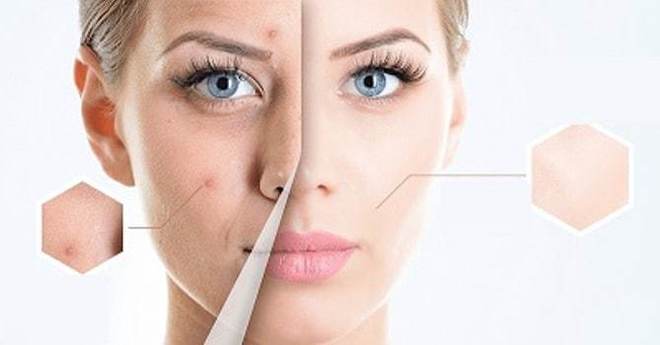 Как да се отървете от акне и черни точки?