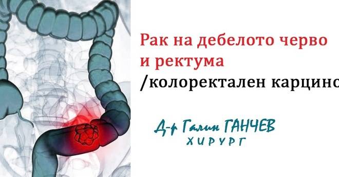 Рак на дебелото черво и ректума – колоректален карцином.