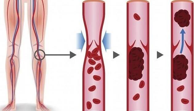 С какво да се храним, за да предотвратим кръвни съсиреци
