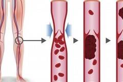 С какво да се храним, за да предотвратим кръвни съсиреци