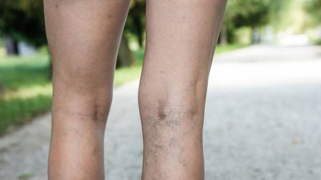 11 съвета и трикове за лечение на разширени вени