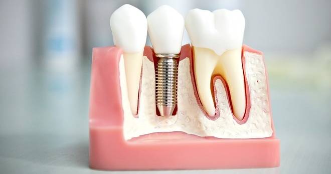 Зъбните имплантати – хит в съвременната дентална медицина