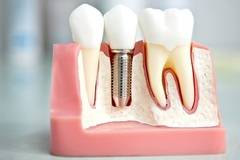 Зъбните имплантати – хит в съвременната дентална медицина