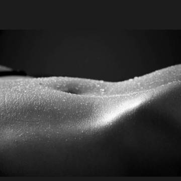 Лазерно премахване на стрии