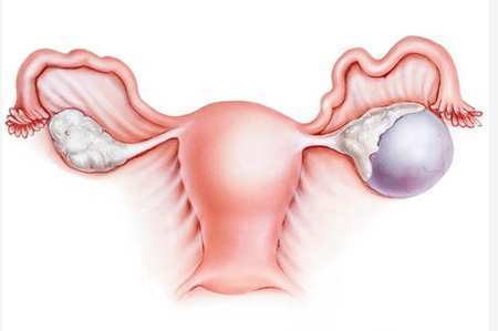 7 симптома на поликистозните яйчници, всяка 10-а жена страда