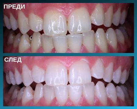 Избелване на зъби – Домашно и Клинично избелване на ТОП цена – IG Dental