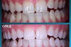 Избелване на зъби – Домашно и Клинично избелване на ТОП цена – IG Dental