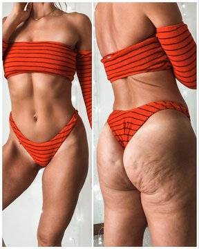 Неприятният и нежелан целулит